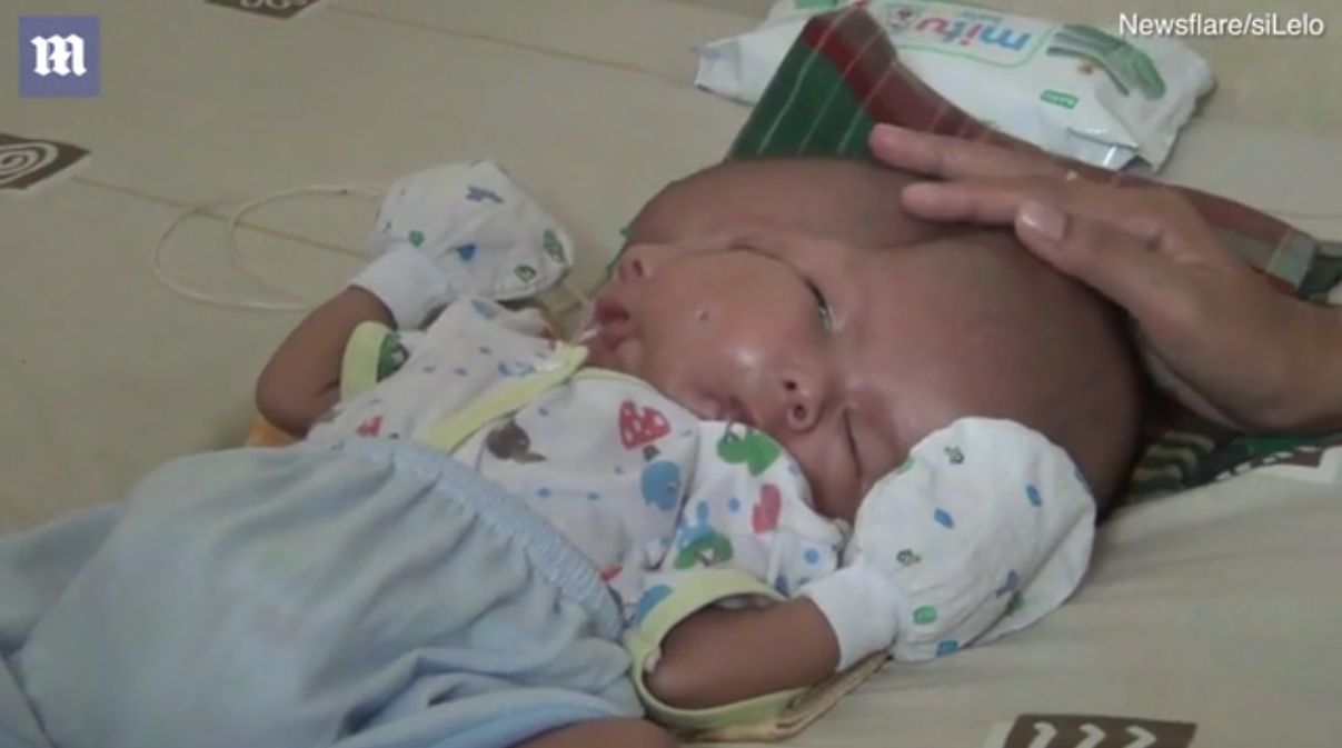 В Індонезії народився хлопчик з двома обличчями