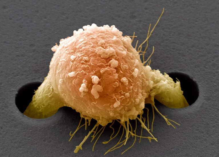 У лабораторному експерименті клітина раку молочної залози (штучно забарвлена) пролазить через підтримуючу плівку.