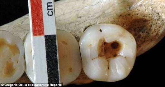 Стоматологи льодовикового періоду: вчені у захваті від зубних пломб віком 14 тисяч років