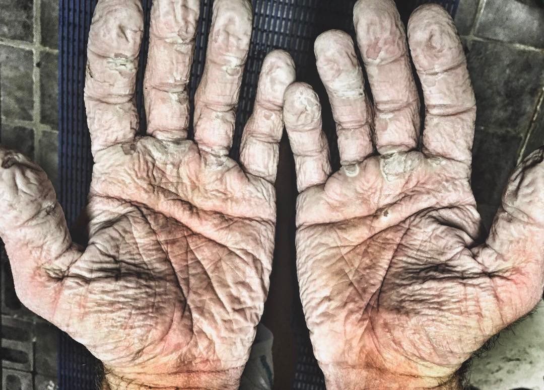 Британський спортсмен показав свої руки після місяця в Північному Льдовитому океані
