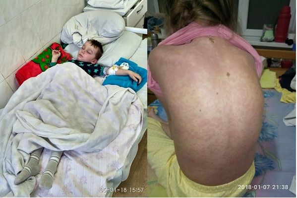 Цирк Кобзов звинувачують у зараженні дітей Києва на кір