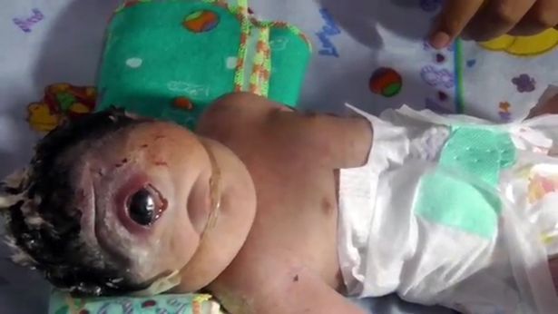 В Індонезії в сім'ї шахтарів народилася дівчинка-циклоп з оком на все обличчя