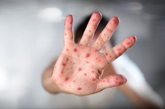 Вірус кору: біологічна зброя чи дитяче захворювання
