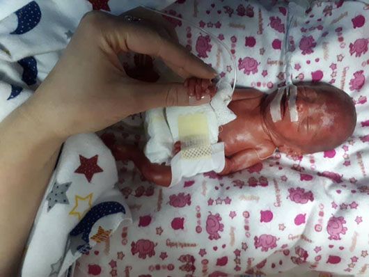 У Тернополі лікарі виходили дівчинку, яка народилася вагою всього 610 грамів