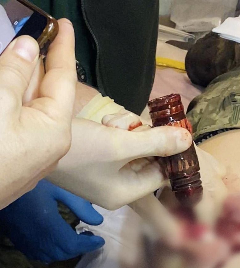 Ангел охоронець не підвів: хірурги вилучили нерозірваний ВОГ з тіла українського бійця