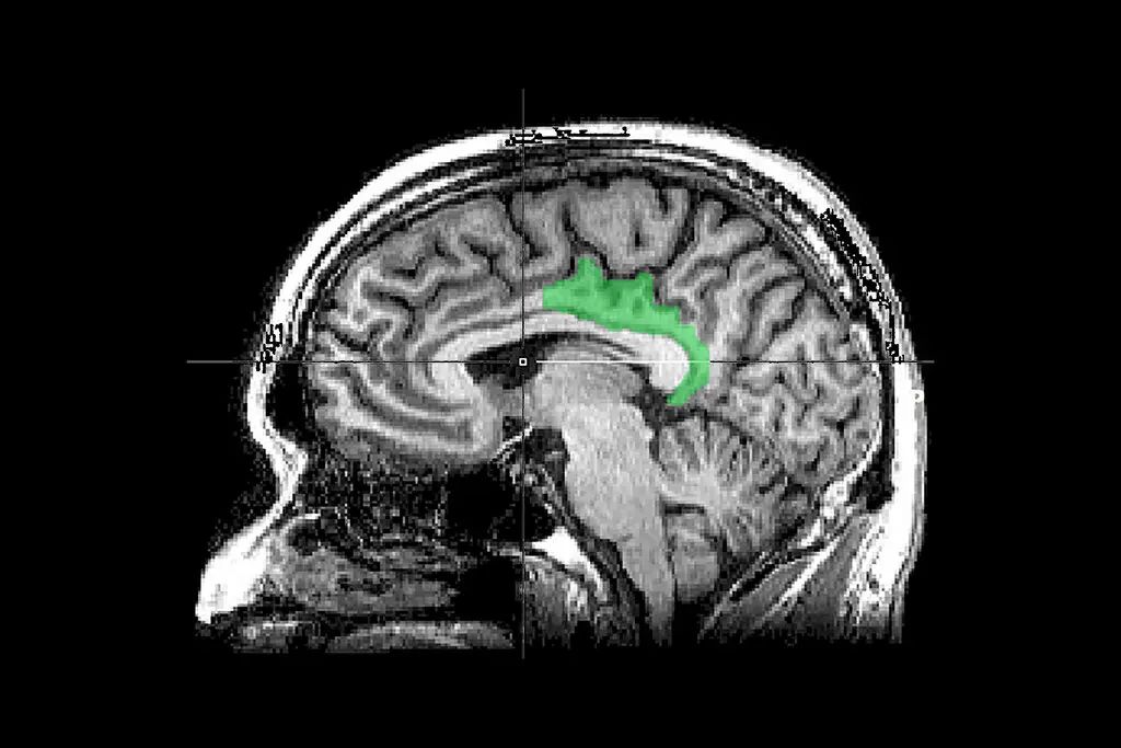 М.Р.І. сканування головного мозку з виділенням задньої поясної кори. У дослідженні виявилося, що травматичні спогади залучають цю сферу, яка зазвичай пов’язана з внутрішньо спрямованими думками, такими як самоаналіз або мріяння.